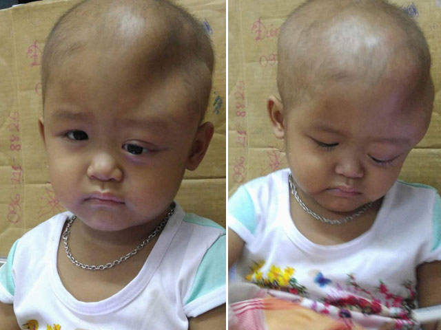 Bướu nguyên bào thần kinh - Hình ảnh minh họa